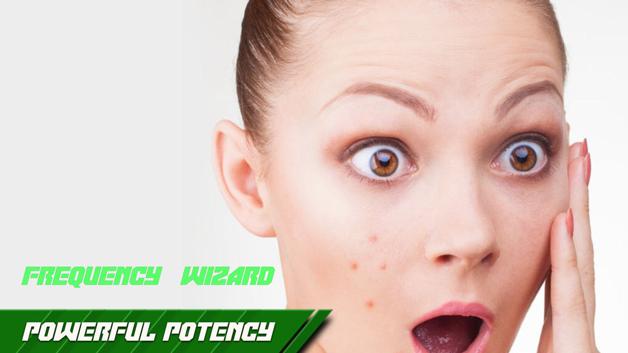 Get Rid of Acne, Pimples, Zits, Blemishes Fast! - Frequency Wizard