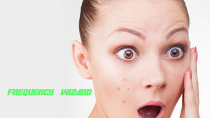 Get Rid of Acne, Pimples, Zits, Blemishes Fast! - Frequency Wizard