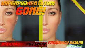 Hyperpigmentation Eliminator (Incredible Results!) Rapid Elimination!