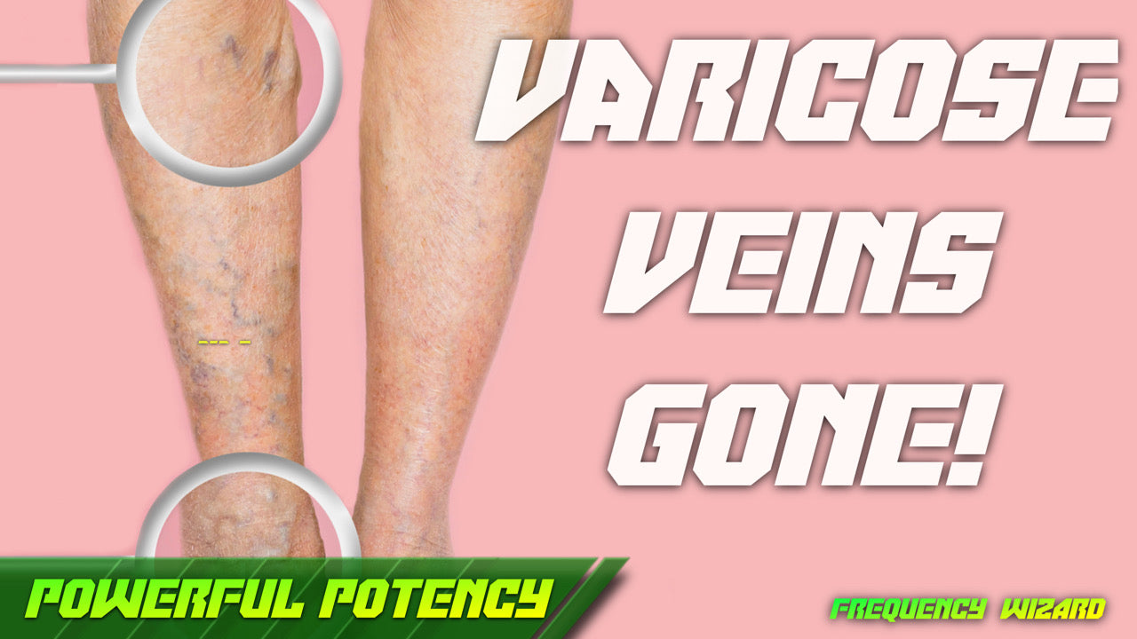 Get Rid of Varicose Veins Fast (Revamped)