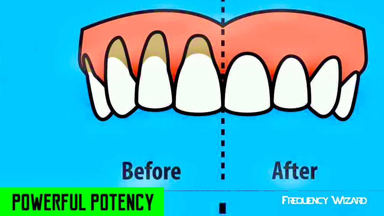 RECEDING GUMS TREATMENT! WORKS FAST! FIX GUM RECESSION SUBLIMINAL SUBCONSCIOUS HYPNOSIS BINAURAL BEATS SPELL - FREQUENCY WIZARD