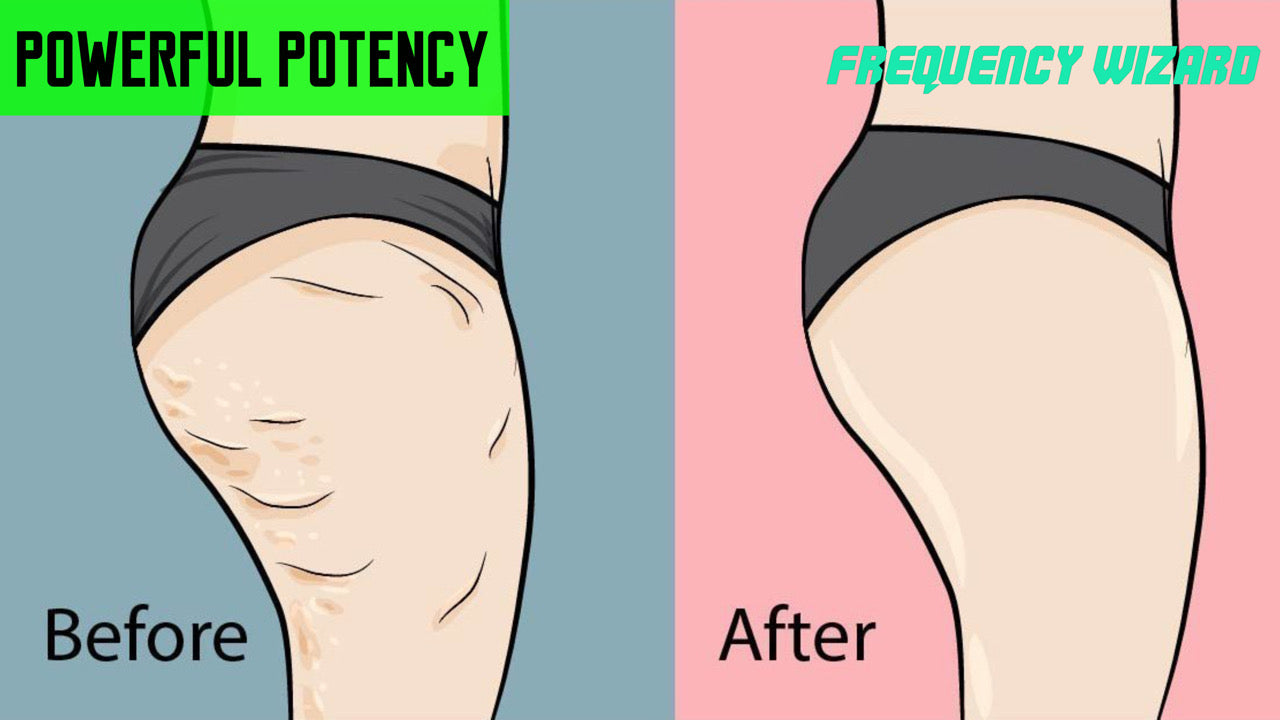 REMOVE STUBBORN CELLULITE FAST - FREQUENCY WIZARD