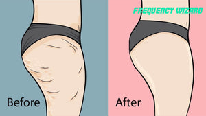 REMOVE STUBBORN CELLULITE FAST - FREQUENCY WIZARD